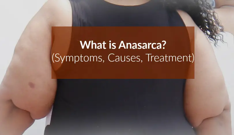 What is Anasarca