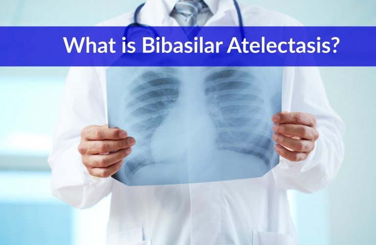 Bibasilar Atelectasis Icd 10 Doctors Reveal The Truth - 4mxwept