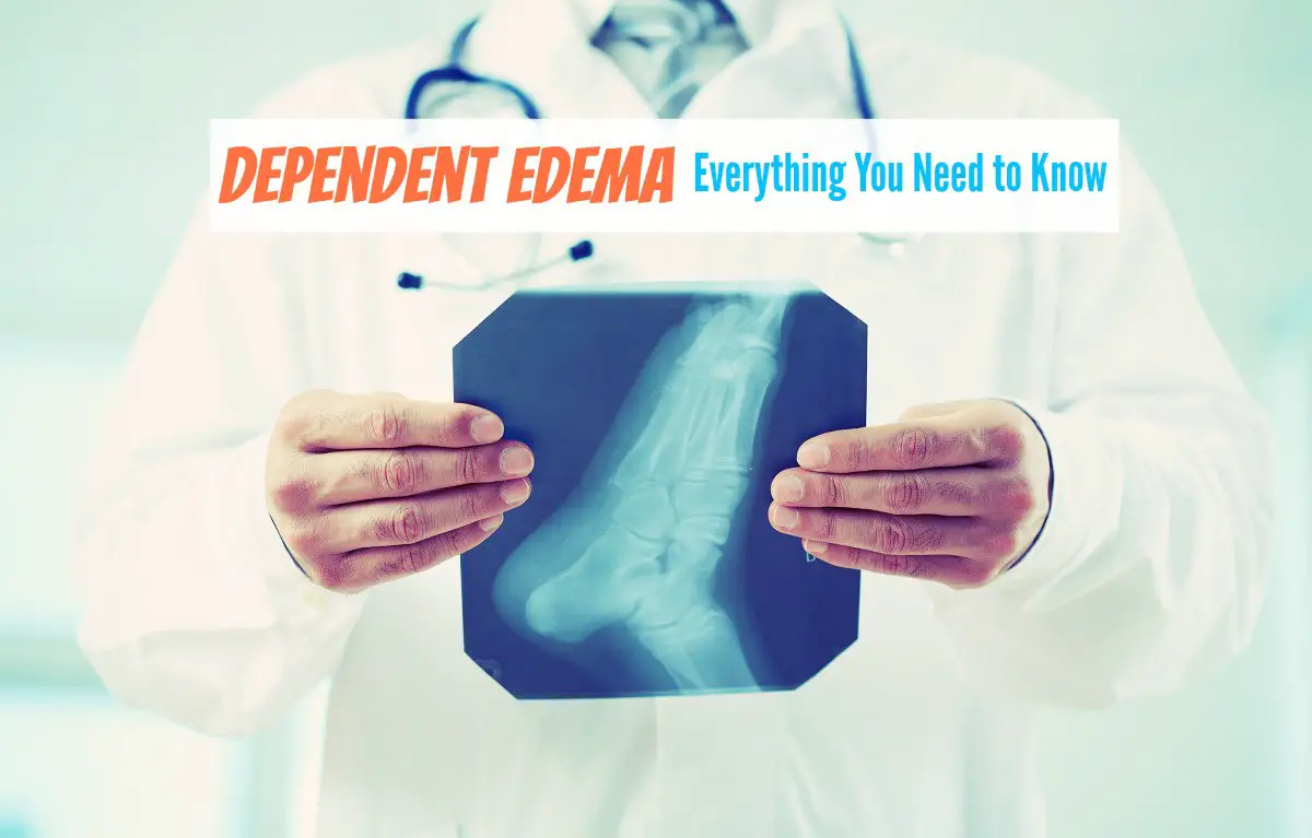 Dependent Edema - Everything You Need to Know