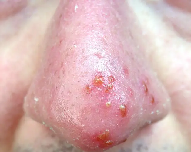 coldsore virus herpes simplex on an infected victims nose